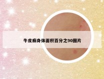 牛皮癣身体面积百分之90图片
