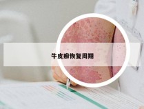 牛皮癣恢复周期