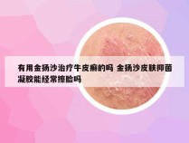 有用金扬沙治疗牛皮癣的吗 金扬沙皮肤抑菌凝胶能经常擦脸吗