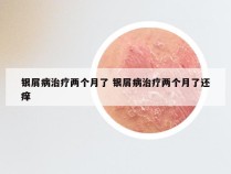银屑病治疗两个月了 银屑病治疗两个月了还痒