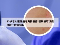 83岁老人银屑病吃海鲜发作 银屑病可以偶尔吃一吃海鲜吗