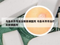 乌鲁木齐专业治银屑病医院 乌鲁木齐市治疗皮肤病医院
