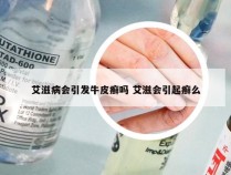 艾滋病会引发牛皮癣吗 艾滋会引起癣么