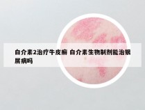 白介素2治疗牛皮癣 白介素生物制剂能治银屑病吗