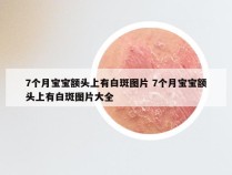 7个月宝宝额头上有白斑图片 7个月宝宝额头上有白斑图片大全