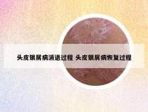 头皮银屑病消退过程 头皮银屑病恢复过程