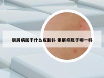 银屑病属于什么皮肤科 银屑病属于哪一科