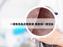 一挠有出血点银屑病 银屑病一挠流血