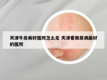 天津牛皮癣好医院怎么走 天津看银屑病最好的医院
