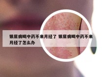 银屑病喝中药不来月经了 银屑病喝中药不来月经了怎么办