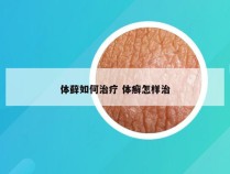体藓如何治疗 体癣怎样治