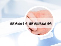银屑病能全瘉吗 银屑病能彻底去根吗