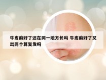牛皮癣好了还在同一地方长吗 牛皮癣好了又出两个算复发吗