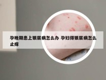 孕晚期患上银屑病怎么办 孕妇得银屑病怎么止痒