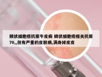 鳞状细胞癌抗原牛皮癣 鳞状细胞癌相关抗原70,,但有严重的皮肤病,满身掉皮皮