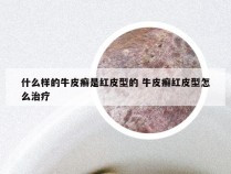 什么样的牛皮癣是红皮型的 牛皮癣红皮型怎么治疗
