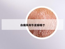 白癜风和牛皮癣哪个