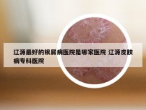 辽源最好的银屑病医院是哪家医院 辽源皮肤病专科医院