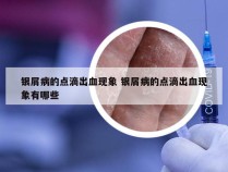 银屑病的点滴出血现象 银屑病的点滴出血现象有哪些