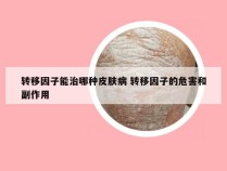 转移因子能治哪种皮肤病 转移因子的危害和副作用