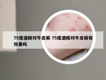 75度酒精对牛皮癣 75度酒精对牛皮癣有效果吗