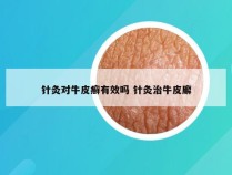 针灸对牛皮癣有效吗 针灸治牛皮廨