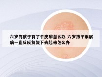 六岁的孩子有了牛皮癣怎么办 六岁孩子银屑病一直反反复复下去起来怎么办