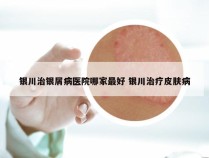 银川治银屑病医院哪家最好 银川治疗皮肤病