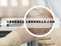 儿童银屑病怎么 儿童银屑病怎么办,心急如焚