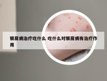 银屑病治疗吃什么 吃什么对银屑病有治疗作用