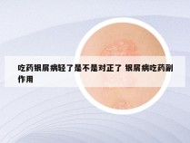 吃药银屑病轻了是不是对正了 银屑病吃药副作用