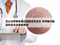 怎么分辨银屑病还是脂溢性皮炎 如何确诊脂溢性皮炎还是银屑病