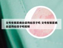 父母有银屑病会遗传给孩子吗 父母有银屑病会遗传给孩子吗视频