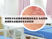 如何区分头皮银屑病和脂溢性皮炎 头皮型银屑病和头皮脂溢性皮炎的区别