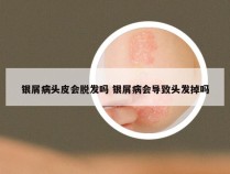 银屑病头皮会脱发吗 银屑病会导致头发掉吗