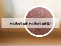 小女孩的牛皮癣 小女孩的牛皮癣图片