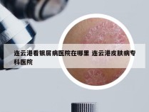 连云港看银屑病医院在哪里 连云港皮肤病专科医院
