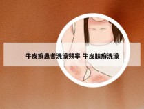 牛皮癣患者洗澡频率 牛皮肤癣洗澡