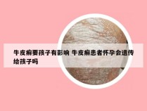 牛皮癣要孩子有影响 牛皮癣患者怀孕会遗传给孩子吗