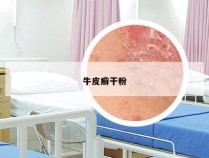 牛皮癣干粉