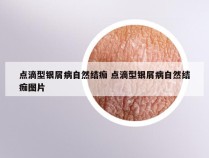 点滴型银屑病自然结痂 点滴型银屑病自然结痂图片
