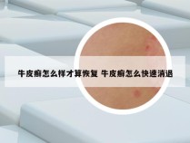 牛皮癣怎么样才算恢复 牛皮癣怎么快速消退