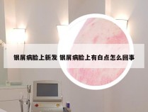 银屑病脸上新发 银屑病脸上有白点怎么回事