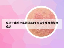 点状牛皮癣什么菌引起的 点状牛皮皮癣初期症状