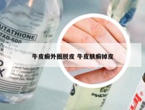 牛皮癣外圈脱皮 牛皮肤癣掉皮