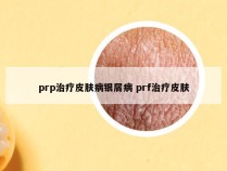 prp治疗皮肤病银屑病 prf治疗皮肤