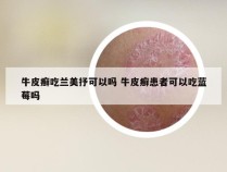 牛皮癣吃兰美抒可以吗 牛皮癣患者可以吃蓝莓吗
