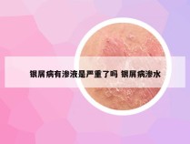 银屑病有渗液是严重了吗 银屑病渗水