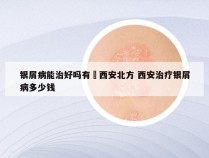 银屑病能治好吗有約西安北方 西安治疗银屑病多少钱