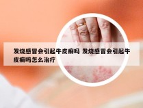 发烧感冒会引起牛皮癣吗 发烧感冒会引起牛皮癣吗怎么治疗